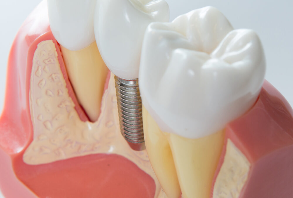 Top Destinations for Dental Implants: A Guide to Dental Tourism